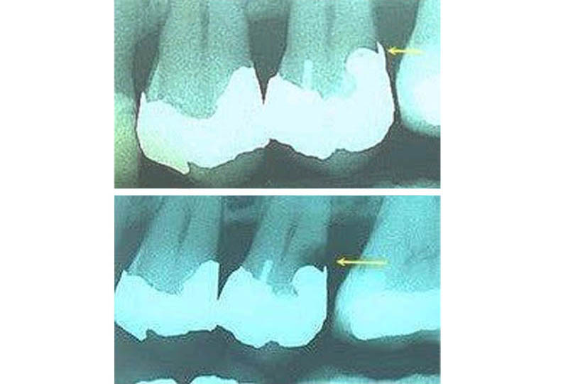 Cavities prevention, Dr. L. Recoder, Baar: regular examination every six months and X-rays every two years