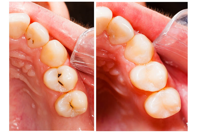 Composite is currently the most accepted standard among all types of fillings